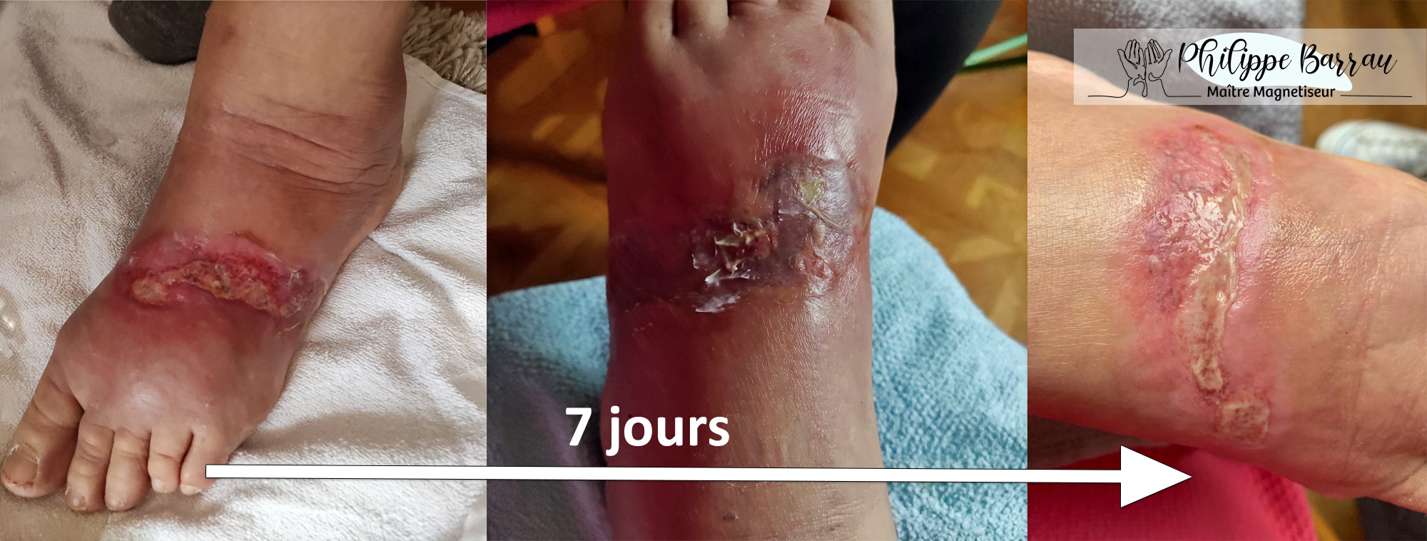 Évolution d’une brûlure apaisée en 7 jours grâce à un soin de magnétisme énergétique, pratiqué par Philippe Barrau, coupeur de feu à Saint-Rémy-de-Provence.